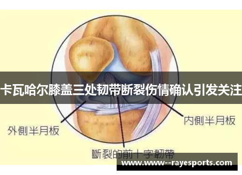卡瓦哈尔膝盖三处韧带断裂伤情确认引发关注